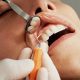 gel gingival