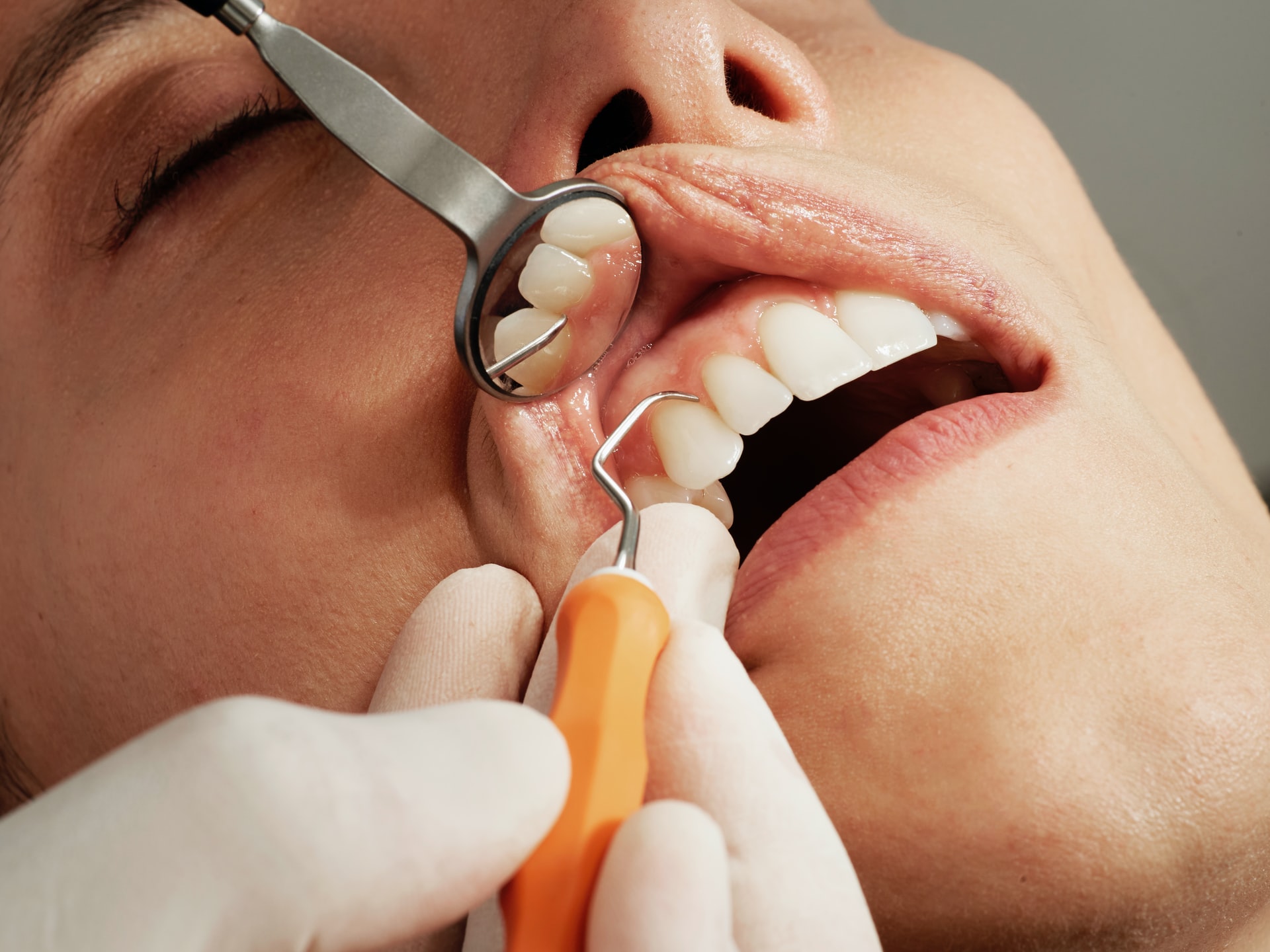 gel gingival