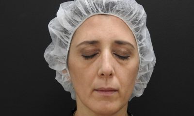 blefaroplastie nonchirurgicala cu laser CO2