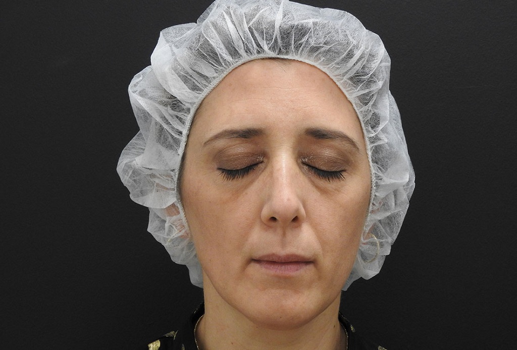 blefaroplastie nonchirurgicala cu laser CO2